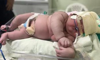 Bayi “Raksasa” Lahir dengan Berat 7,3 Kg di Brasil