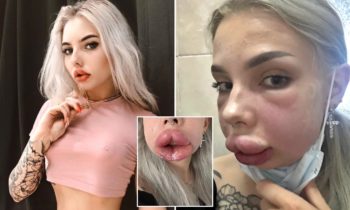 Influencer Cantik Rusia Nyaris Meninggal karena Komplikasi Pengecilan Bibir