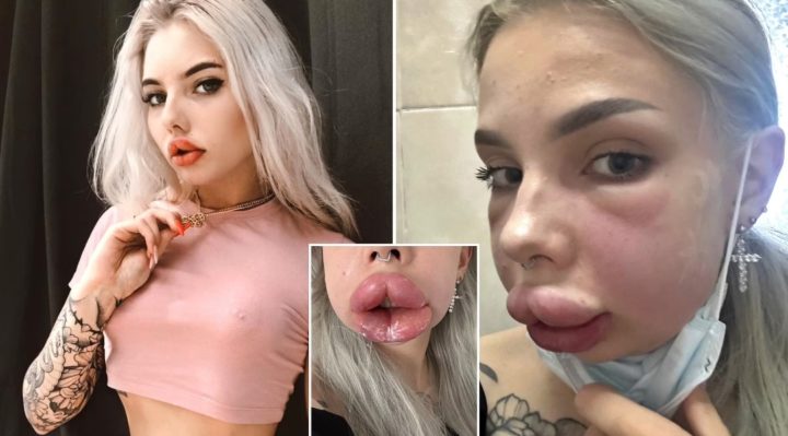 Influencer Cantik Rusia Nyaris Meninggal karena Komplikasi Pengecilan Bibir
